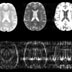 New algorithm could substantially speed up MRI scans